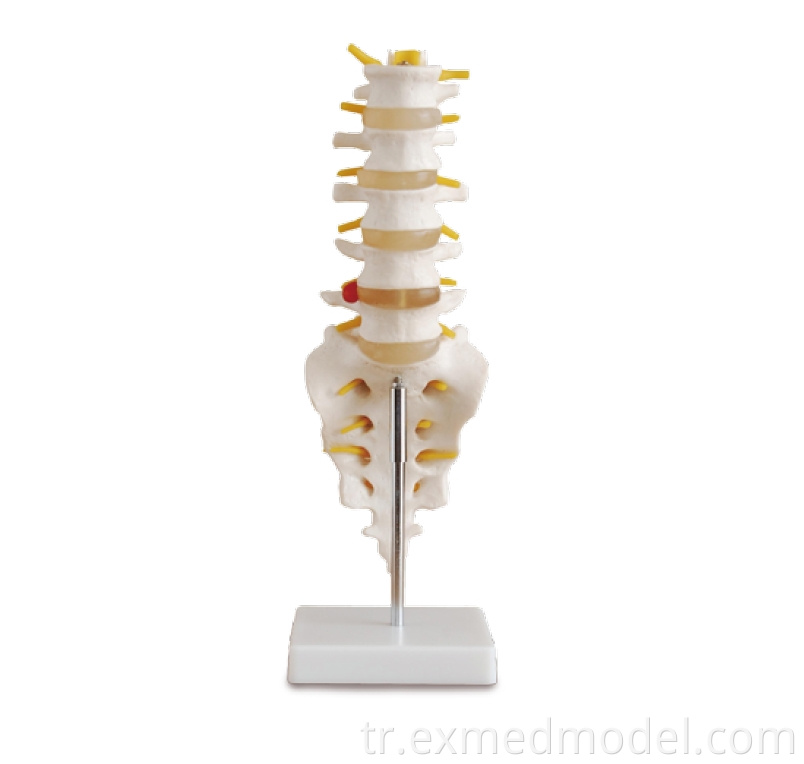 Life-size Lumbar Vertebra with Sacrum & Coccyx and Herniated Disc